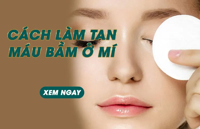 Cách Làm Tan Máu Bầm Ở Mí Mắt Hiệu Quả Không Phải Ai Cũng Biết