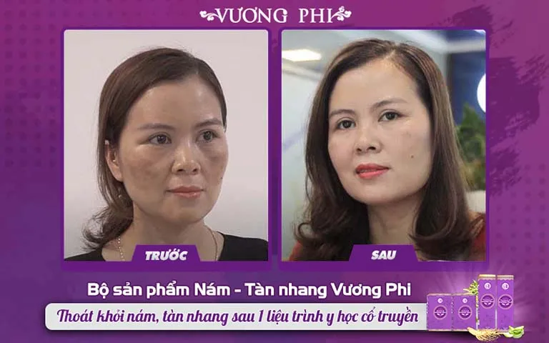 Khách hàng Nguyễn Thị Mơ và kết quả sau 1 liệu trình