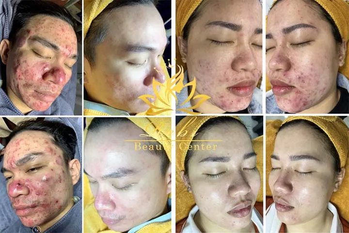 Hình ảnh trị mụn của reby spa uy tín tại TPHCM 