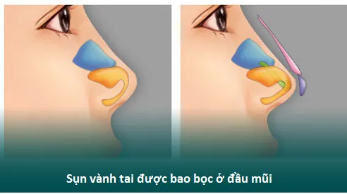 Nâng mũi bằng sụn tai bao nhiêu? Chi phí giúp kết quả duy trì vĩnh viễn - Hình 2