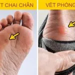 Vết phồng rộp da chân khi mang giày